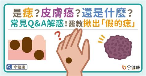 痣是凸的|是痣or皮膚癌？醫「1張圖秒對照」 長這2部位最危險